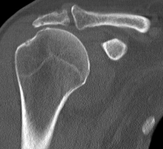 RC Arthropathy CT